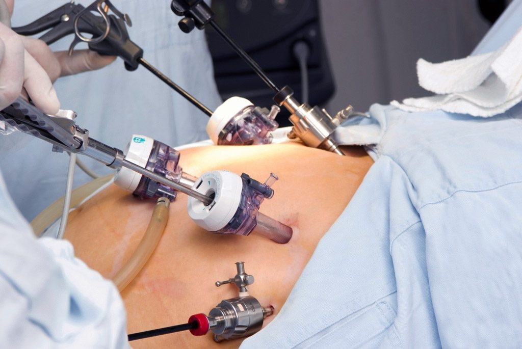 laparoscopic-surgery